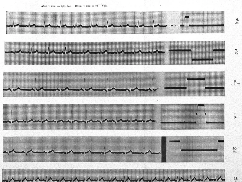 ECG / EKG — representative photo